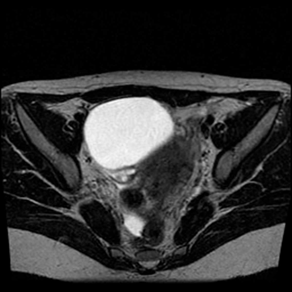 Mucinous cystadenoma of the ovary - CTisus CT Scan