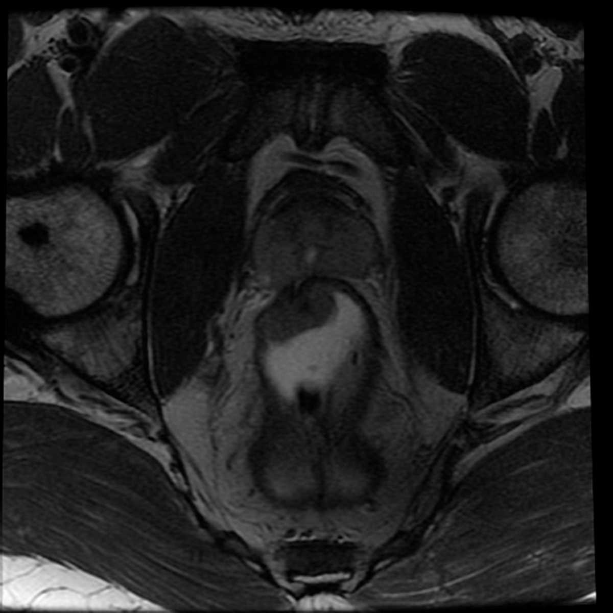 Rectal cancer - CTisus CT Scan