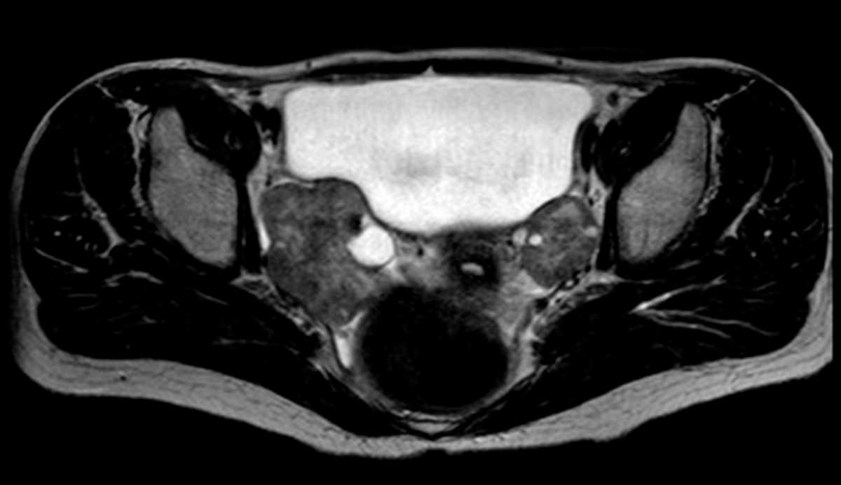 Bilateral ovarian metastases - CTisus CT Scan