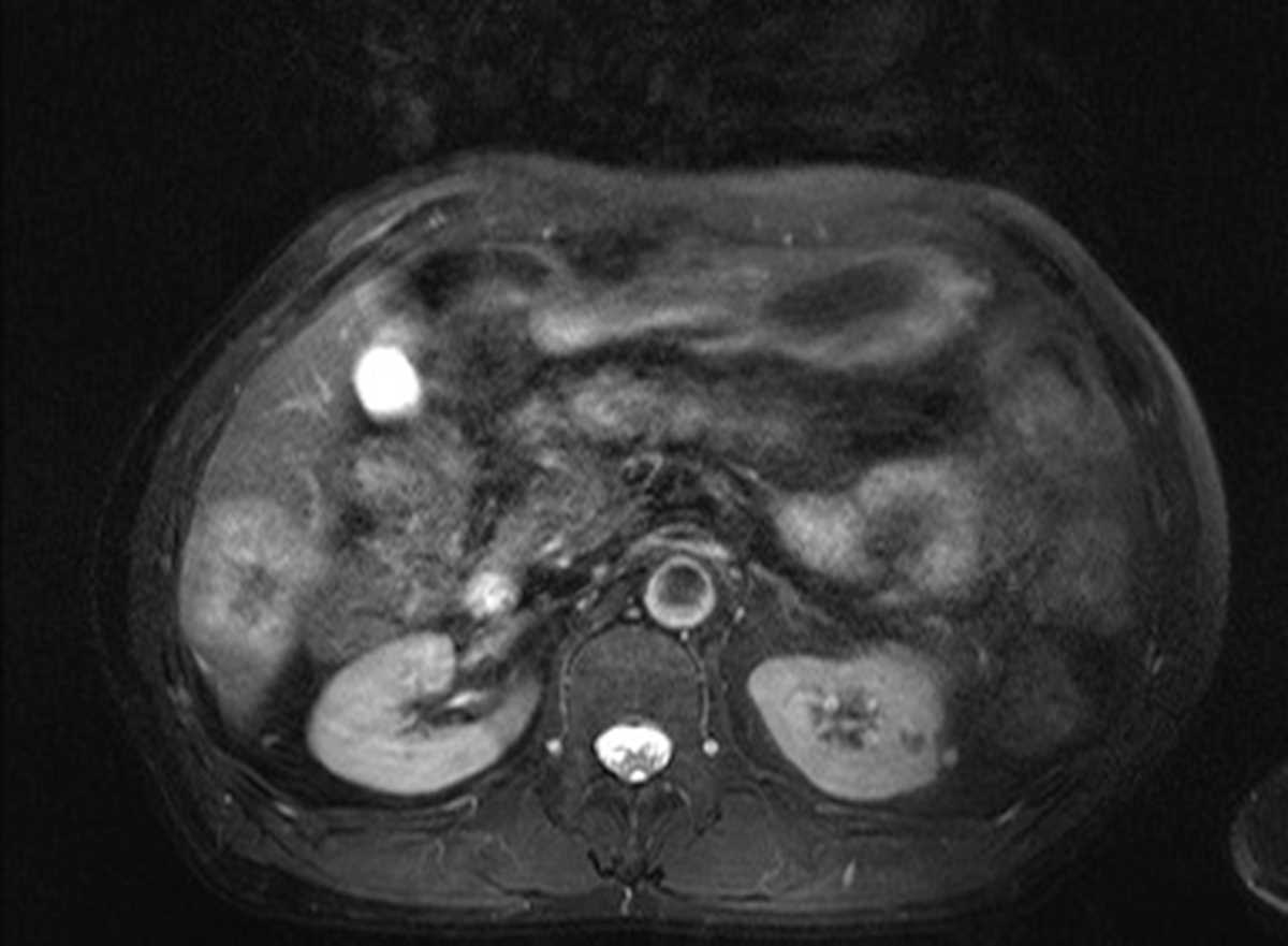 Intrahepatic cholangiocarcinoma - CTisus CT Scan