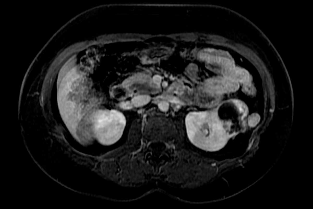Cystic renal cell carcinoma - CTisus CT Scan