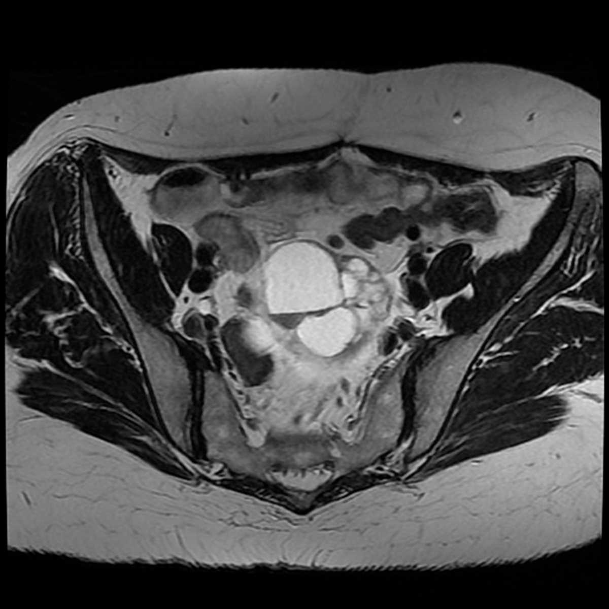 Serous carcinoma of the ovary - CTisus CT Scan