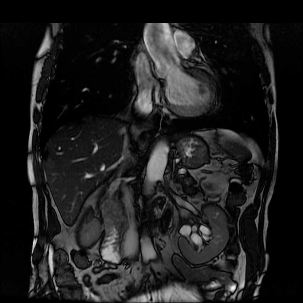 Duodenal adenocarcinoma - CTisus CT Scan
