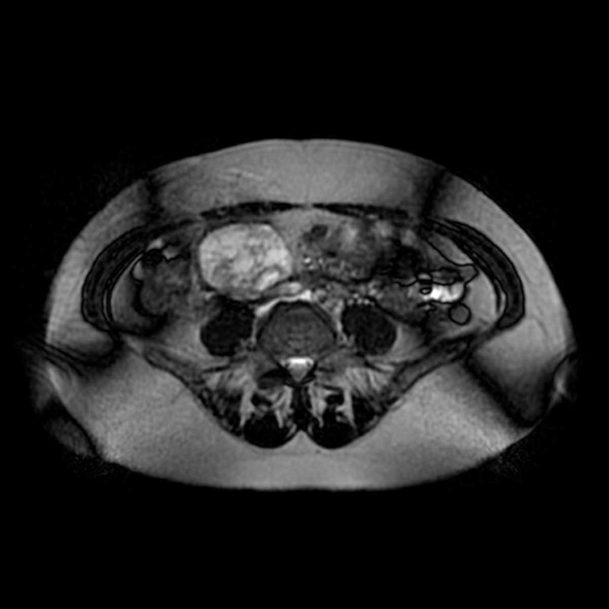Retroperitoneal paraganglioma - CTisus CT Scan