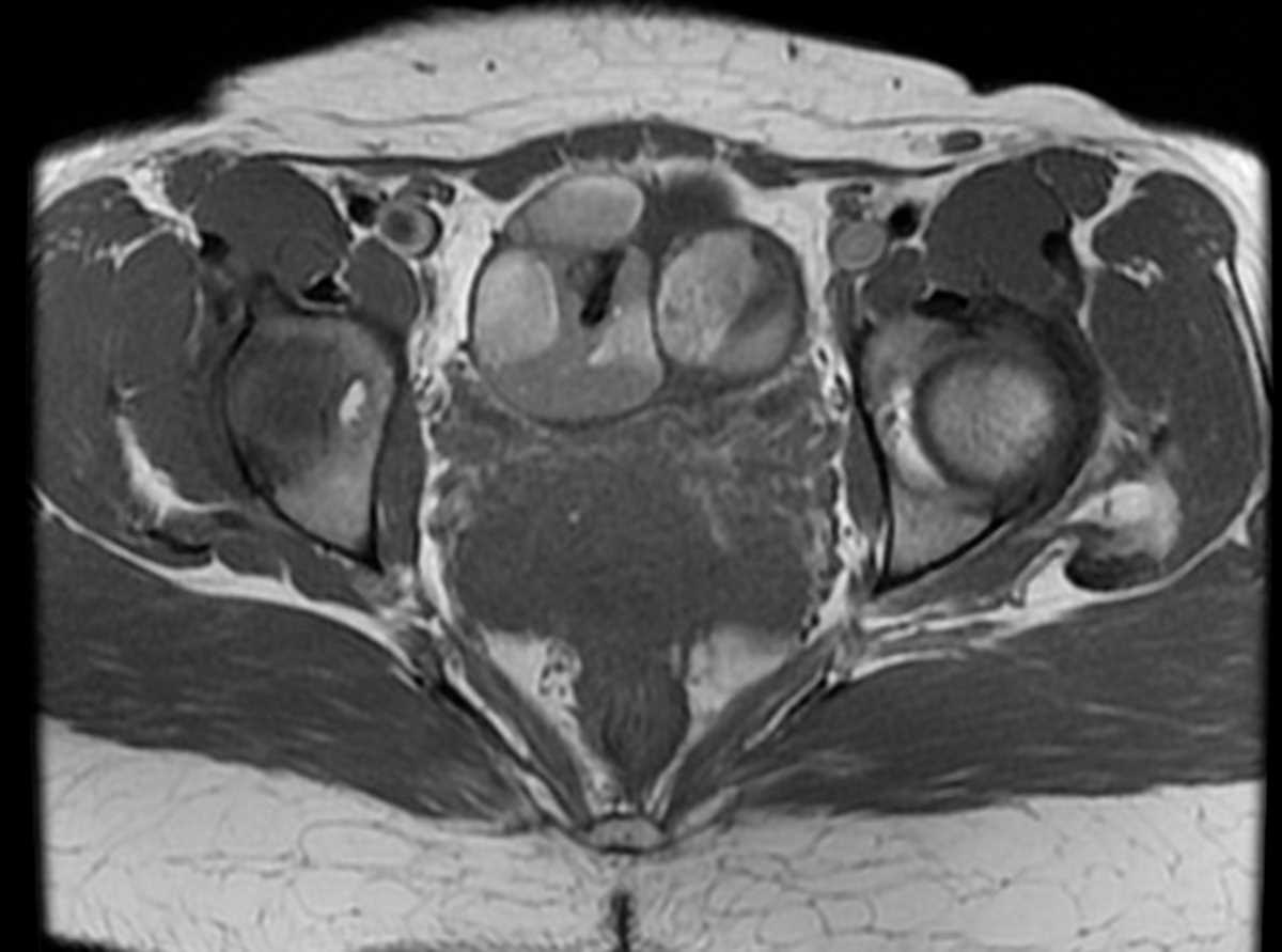Bilateral ovarian dermoids - CTisus CT Scan