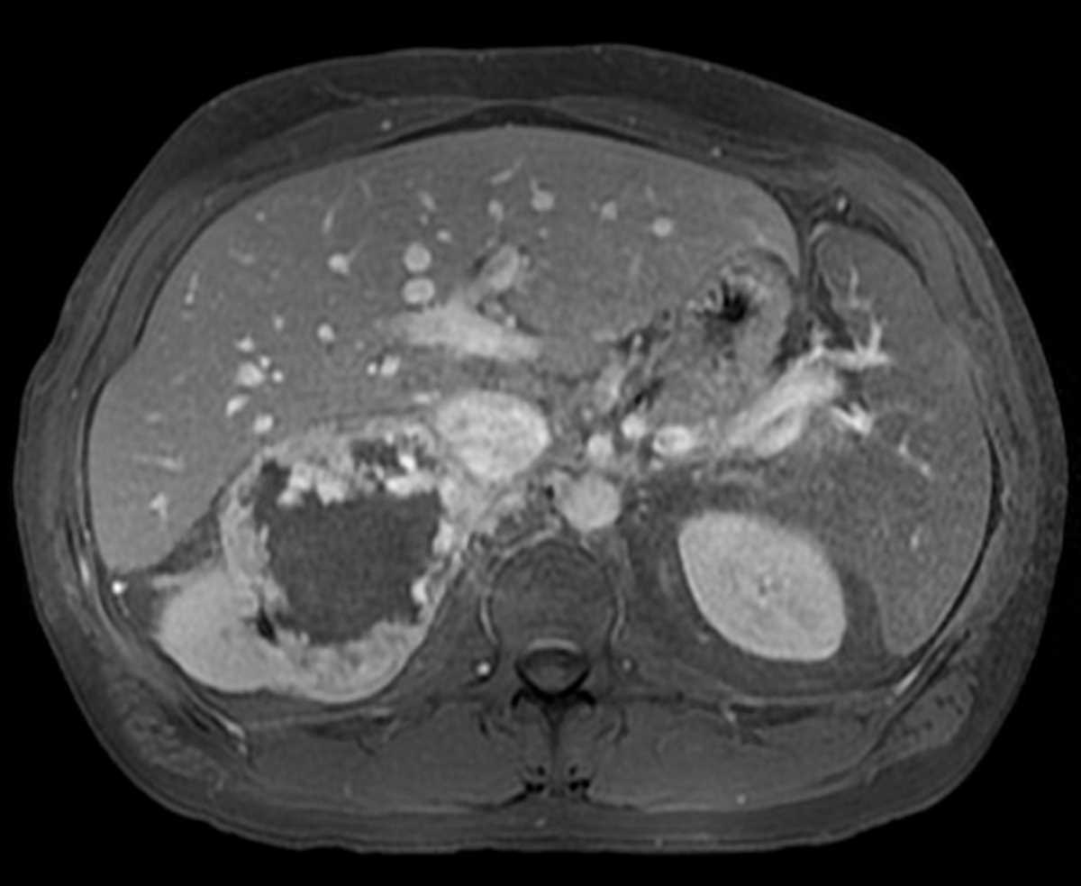 Renal cell carcinoma with renal vein and Inferior Vena Cava (IVC) invasion - CTisus CT Scan