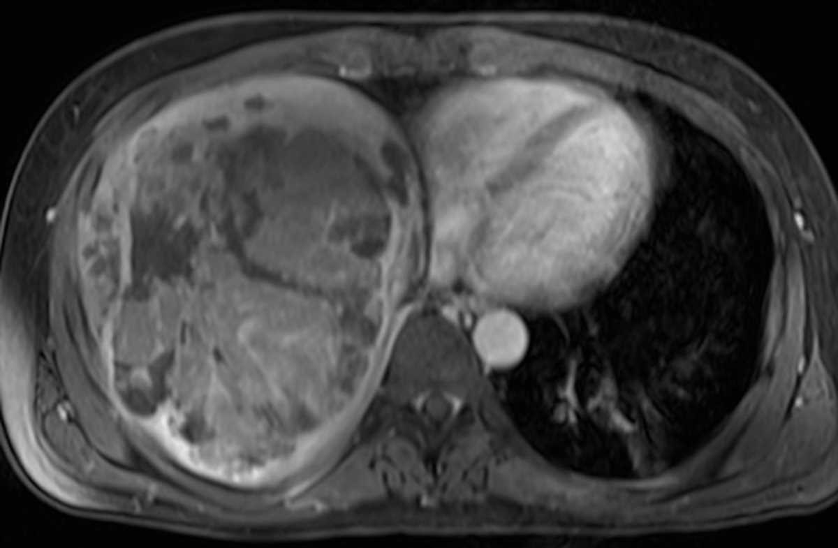 Large Hepatocellular Carcinoma (Hepatoma) (HCC) - CTisus CT Scan