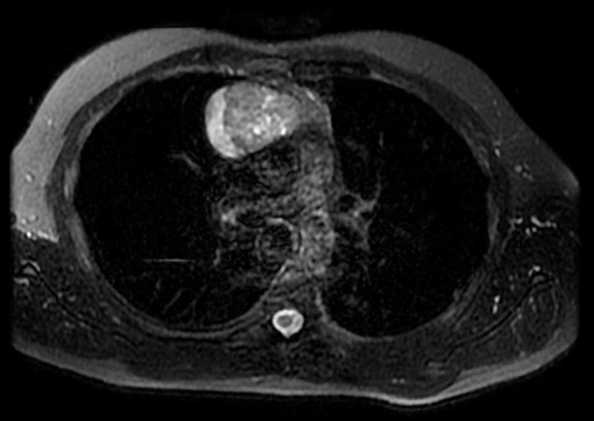 Thymoma - Body MR Case Studies - CTisus CT Scanning