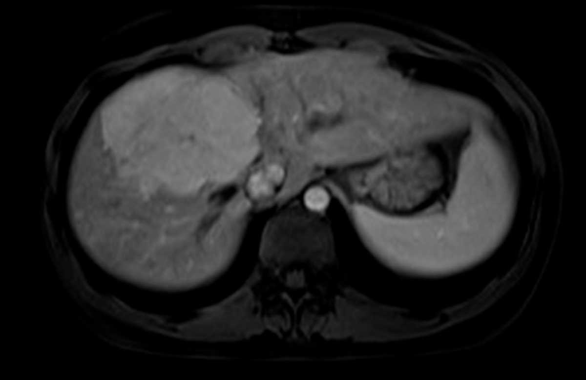 Focal nodular hyperplasia (FNH) - CTisus CT Scan