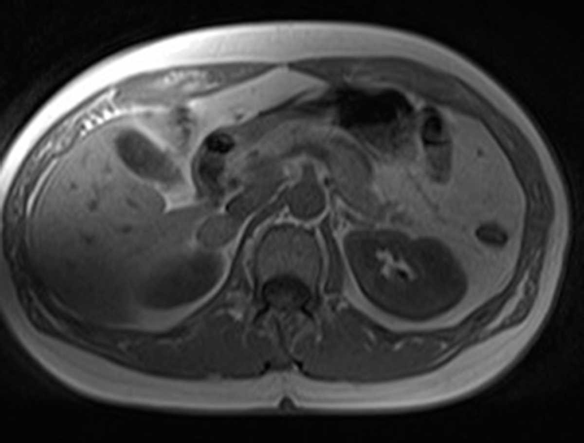 Adrenal adenoma - CTisus CT Scan