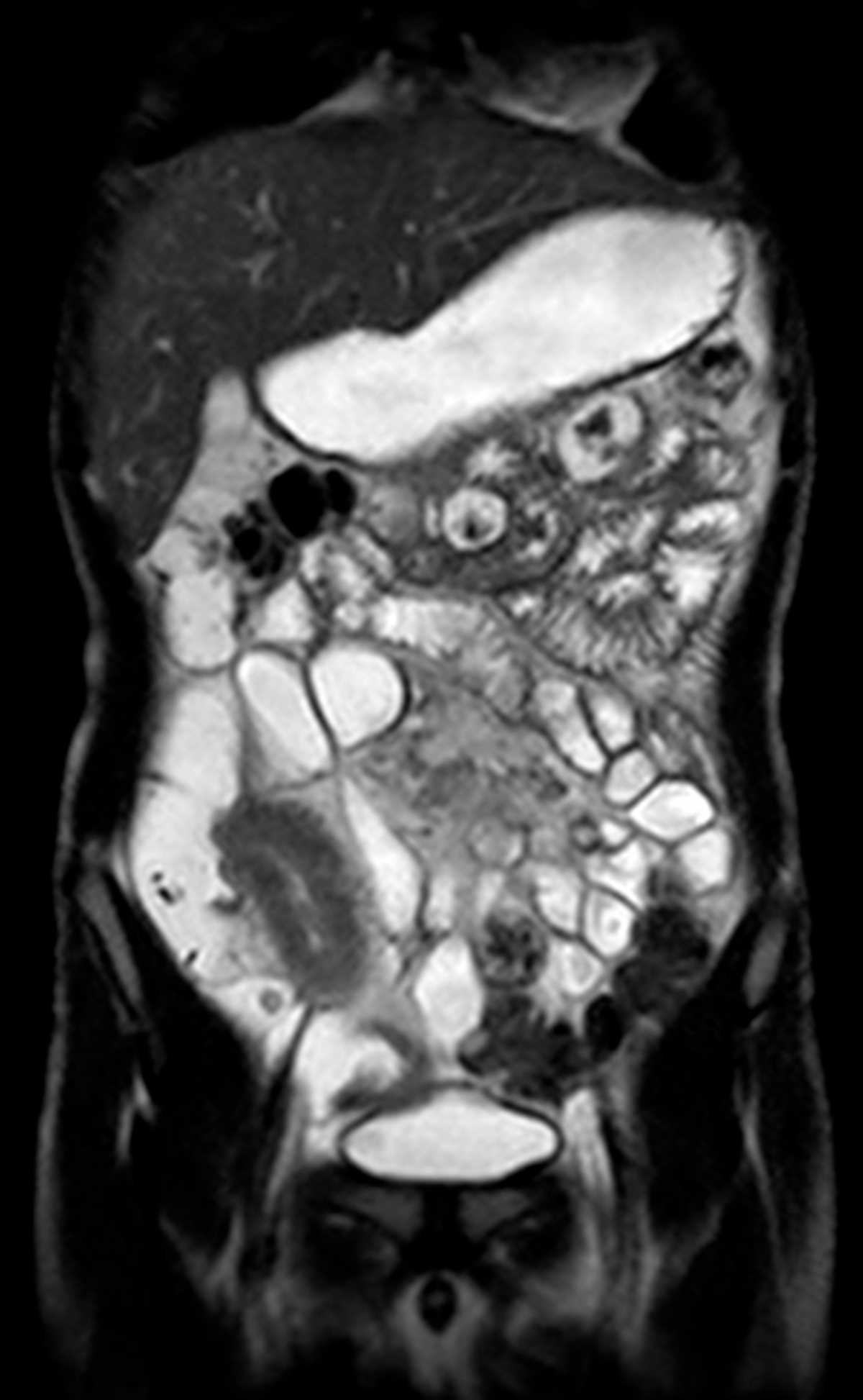 Crohn's disease - CTisus CT Scan