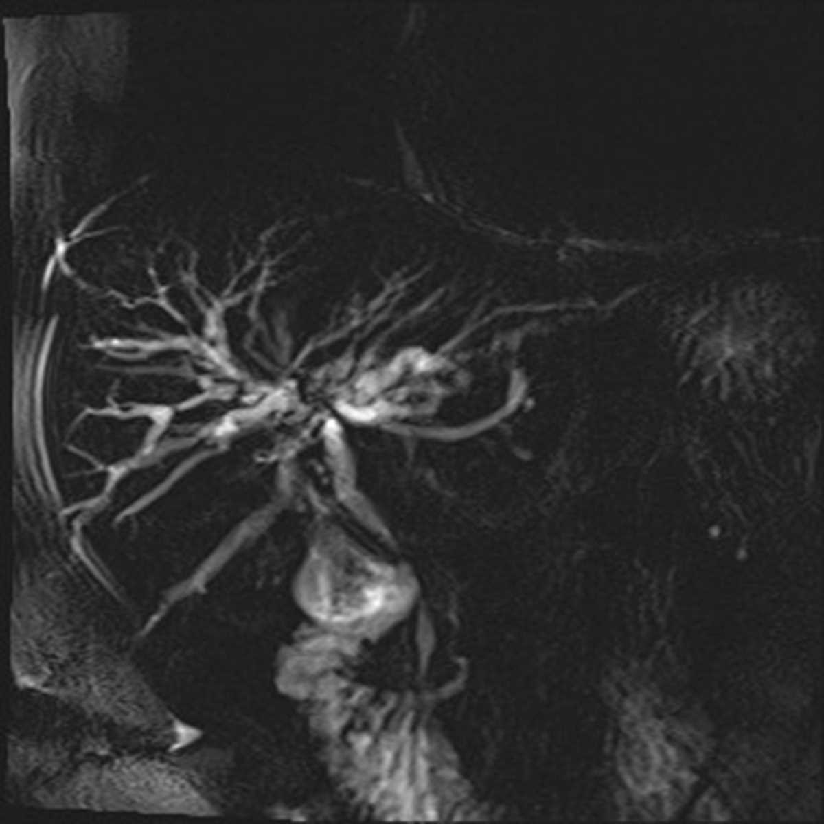 Primary Sclerosing Cholangitis (PSC) - CTisus CT Scan