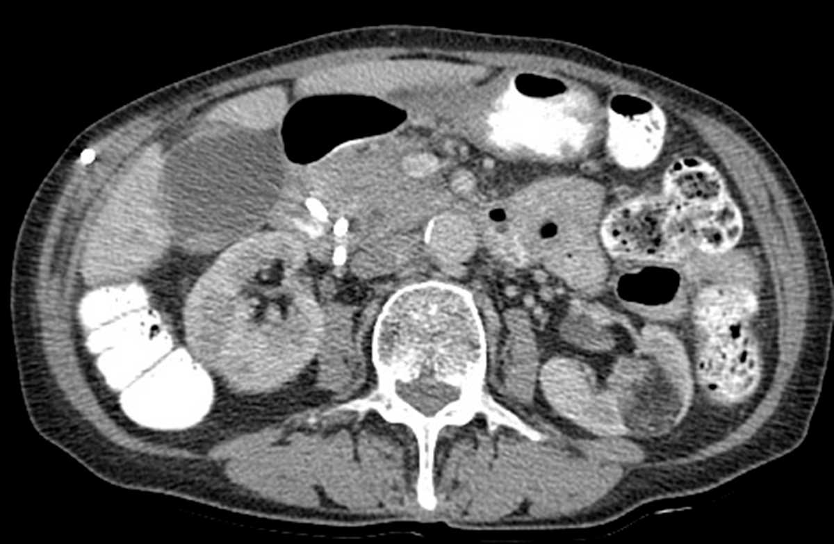 Angiomyolipoma (AML) of kidney - Body MR Case Studies - CTisus CT Scanning