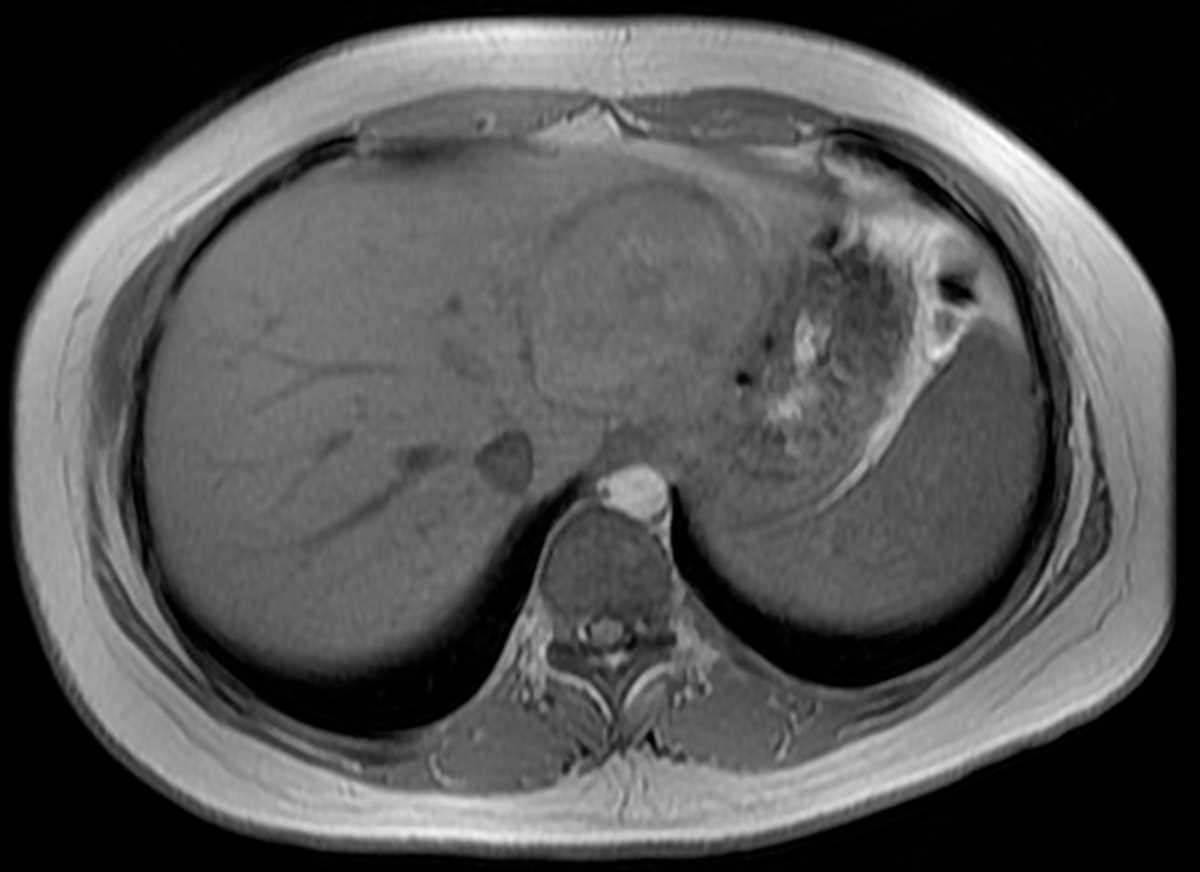 Hepatic adenoma - CTisus CT Scan