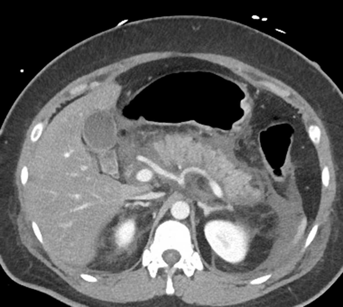 Acute pancreatitis - CTisus CT Scan