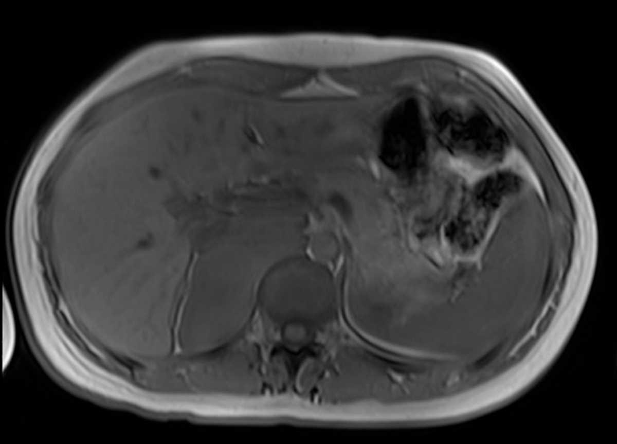 Retroperitoneal neurofibroma - CTisus CT Scan