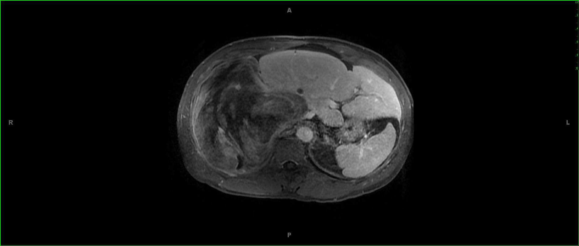 Dedifferentiated Retroperitoneal Liposarcoma - CTisus CT Scan