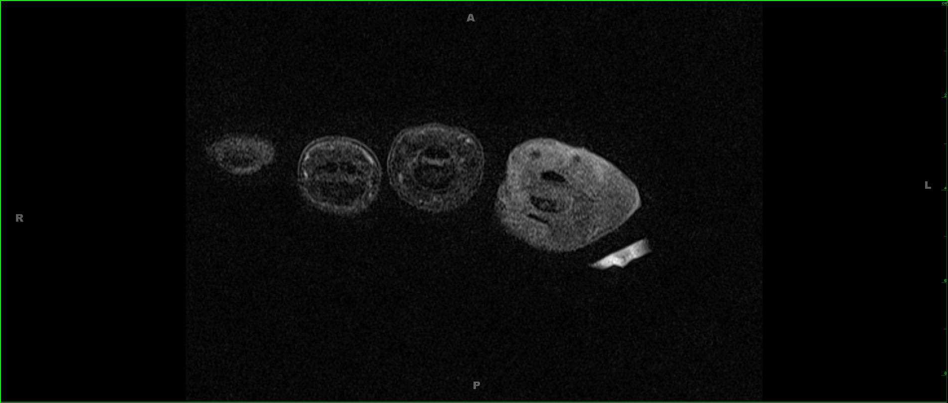 Tophaceous Gout, Hand - CTisus CT Scan