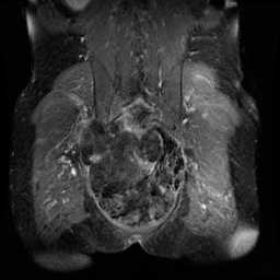 Chordoma, Sacrum - CTisus CT Scan