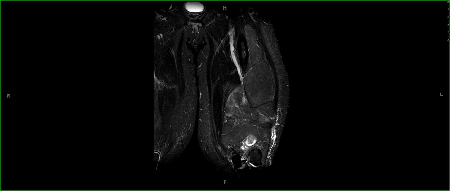 Well-differentiated Liposarcoma, Left Thigh - CTisus CT Scan