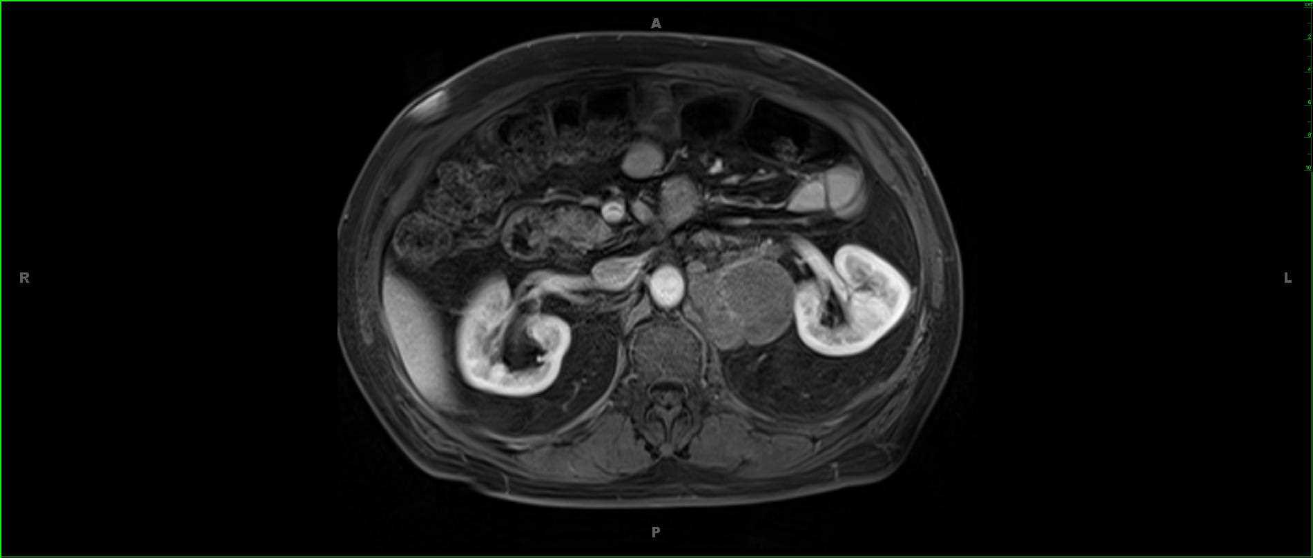 B-Cell Lymphoma, Retroperitoneal - CTisus CT Scan