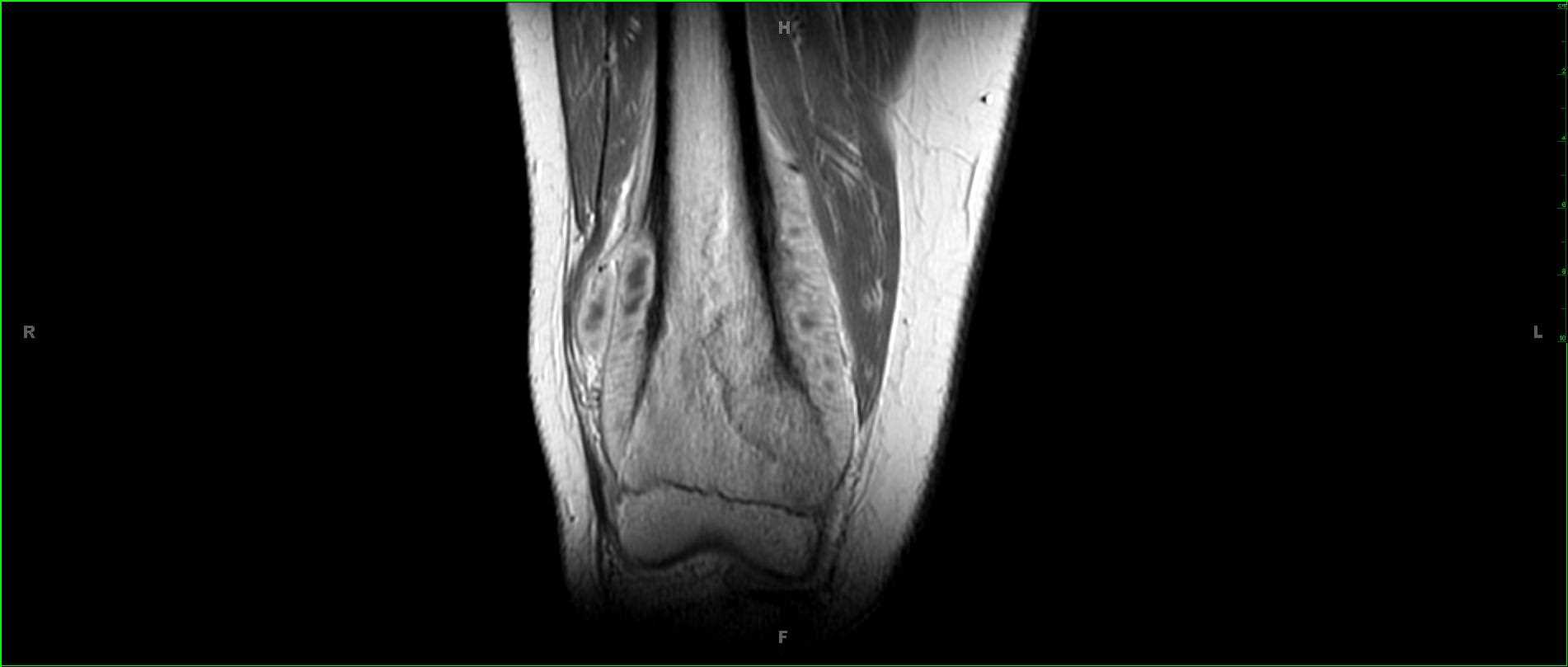 Conventional Osteosarcoma, Distal Left Femur - CTisus CT Scan