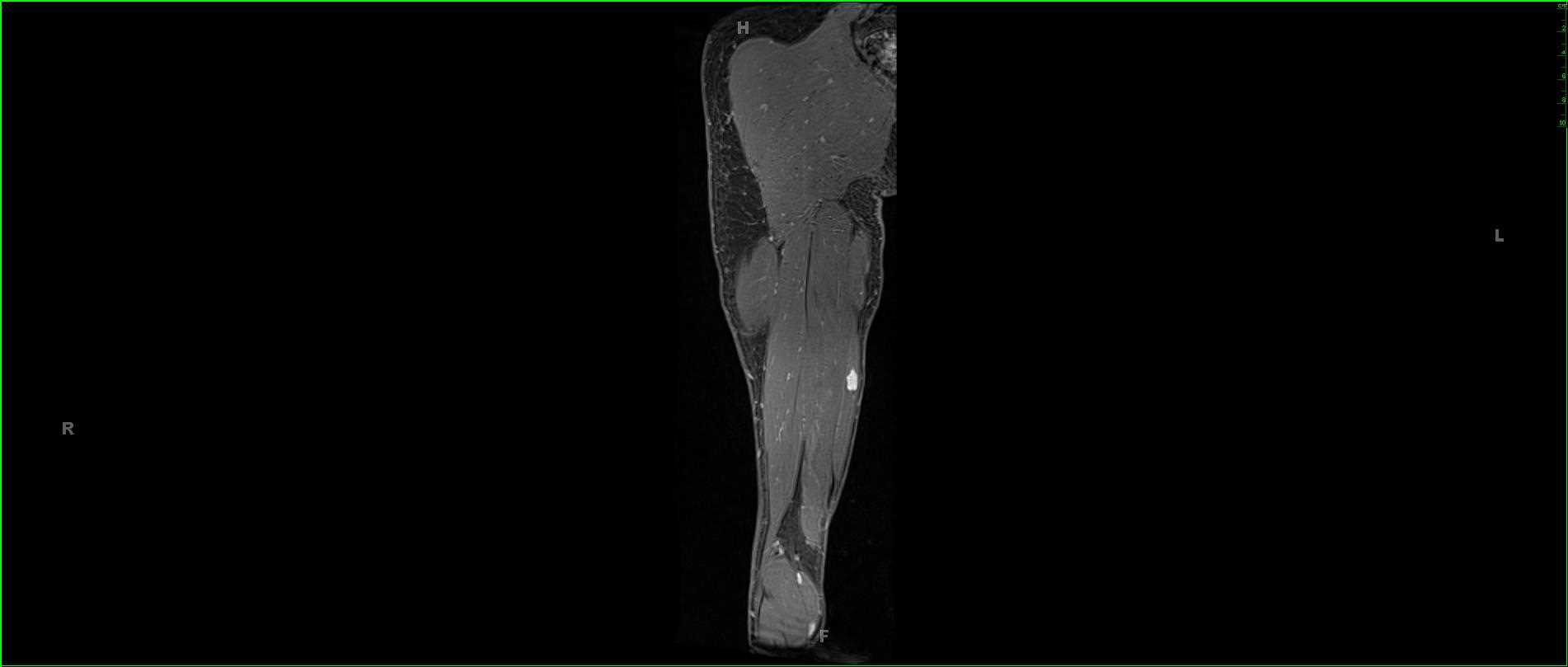 Intramuscular Schwannoma - CTisus CT Scan