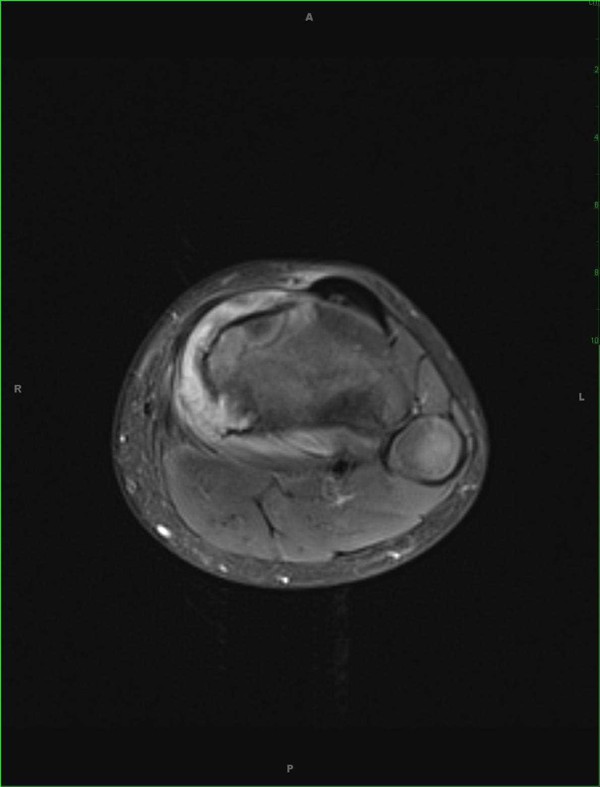 Periosteal Osteosarcoma, Tibia - CTisus CT Scan