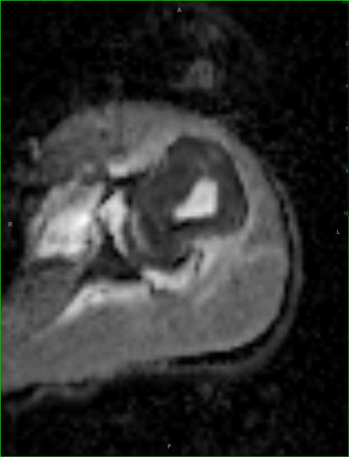 Giant Cell Tumor, Humerus - CTisus CT Scan