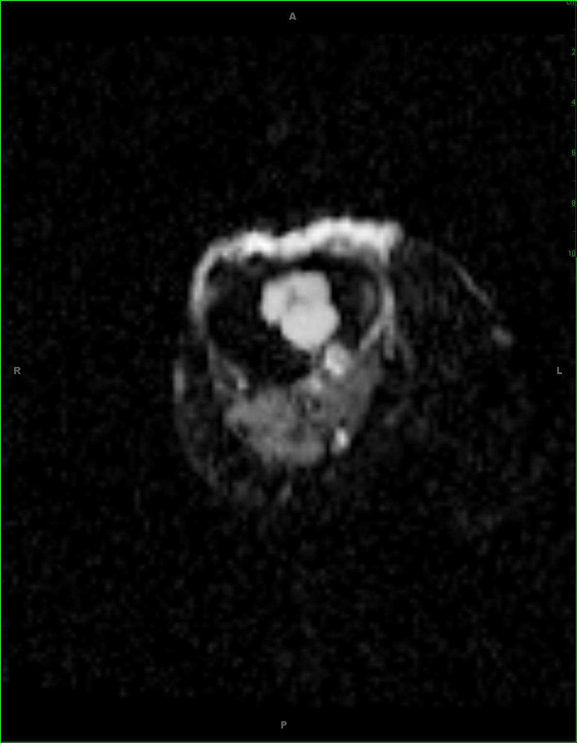 Enchondroma, Tibia - CTisus CT Scan