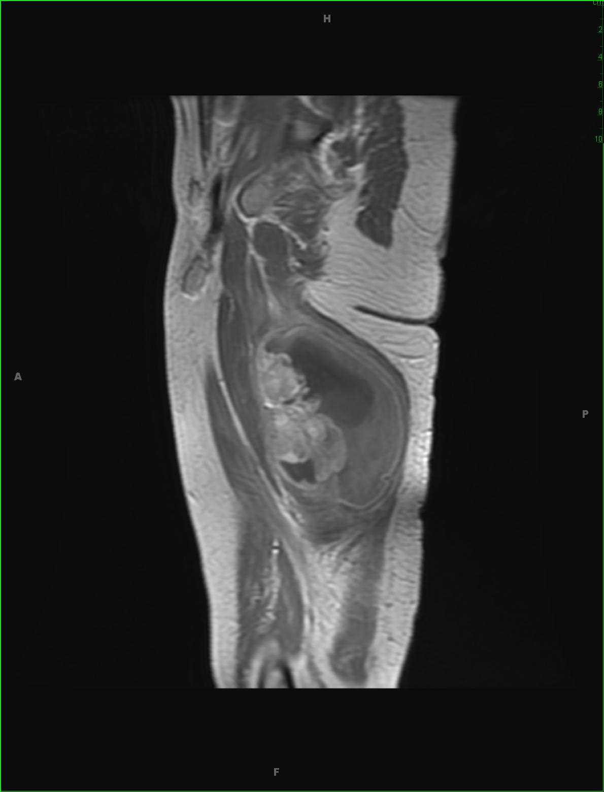 Synovial Sarcoma, Thigh - CTisus CT Scan