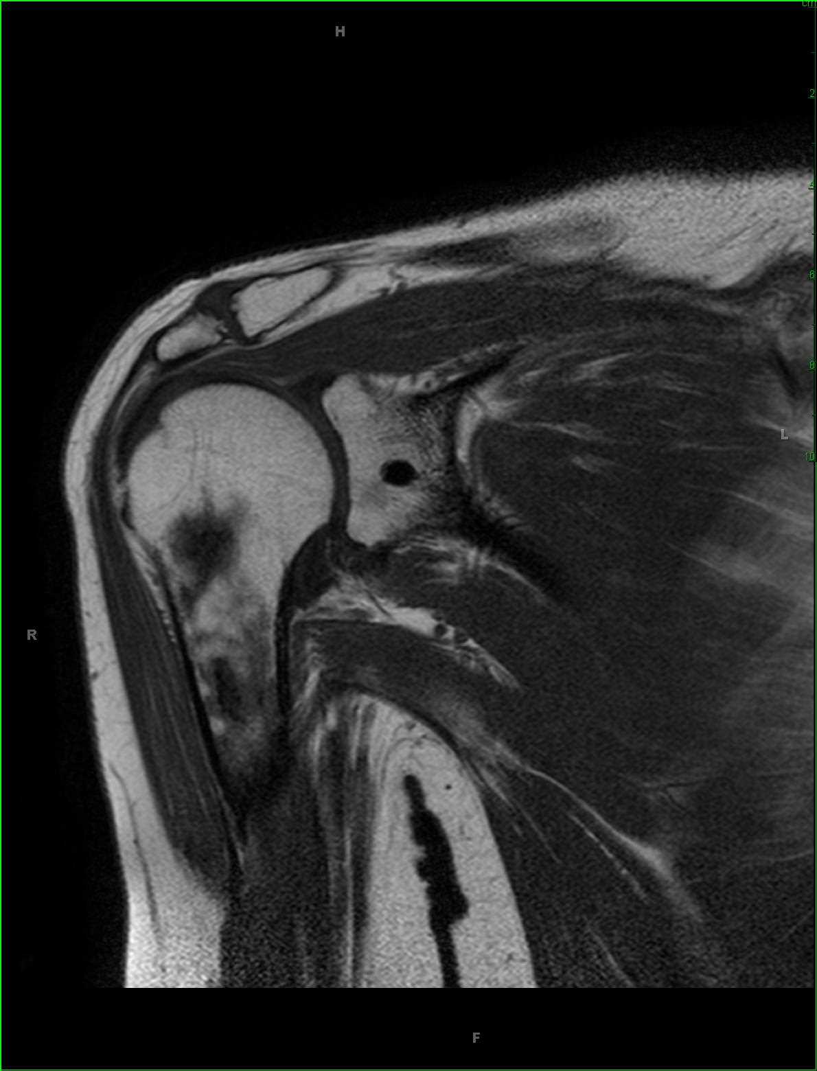 Bone Infarct, Humerus - CTisus CT Scan