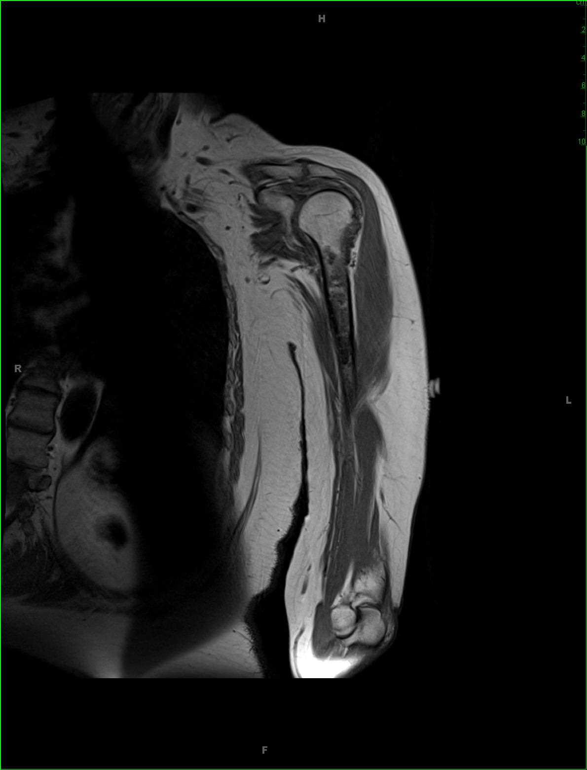 Conventional Chondrosarcoma, Humerus - CTisus CT Scan