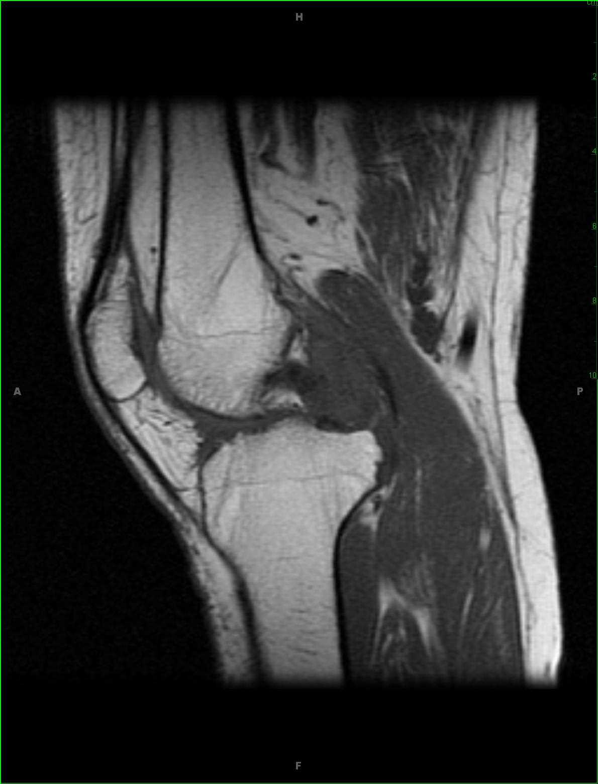 Pigmented Villonodular Synovitis, Knee - CTisus CT Scan