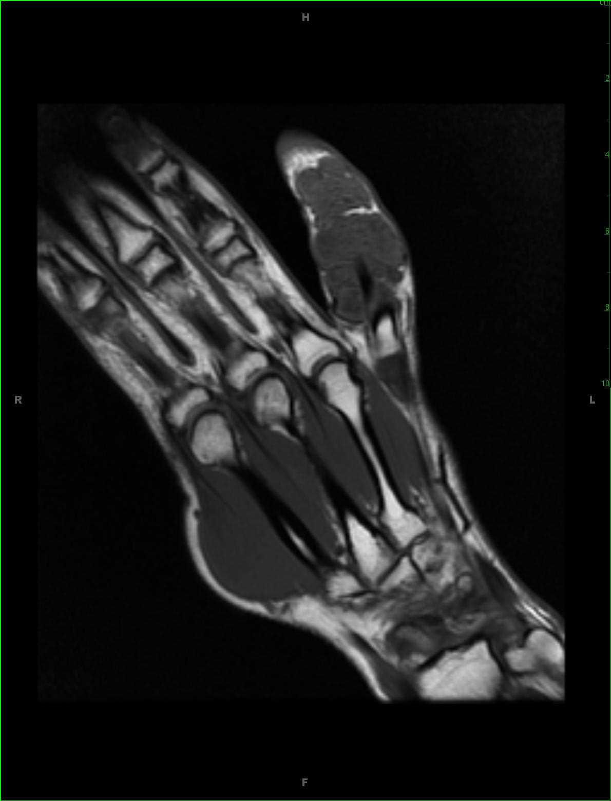 Giant Cell Tumor of the Tendon Sheath, Hand - CTisus CT Scan