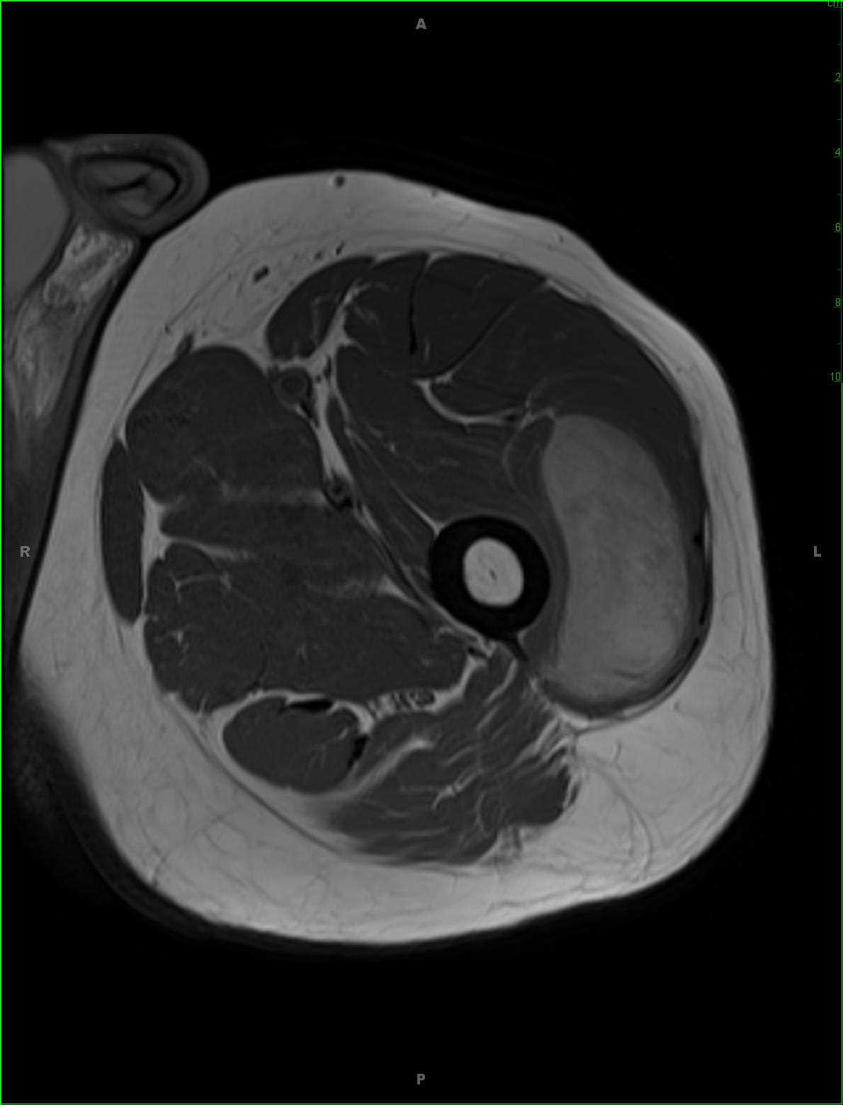 Pleomorphic Sarcoma, Thigh - CTisus CT Scan