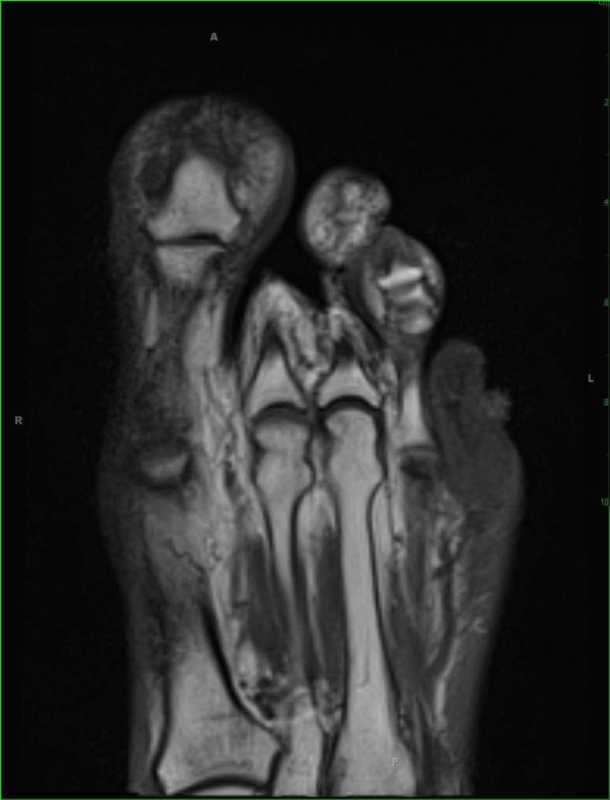 Squamous Cell Carcinoma 5th Digit Foot - CTisus CT Scan