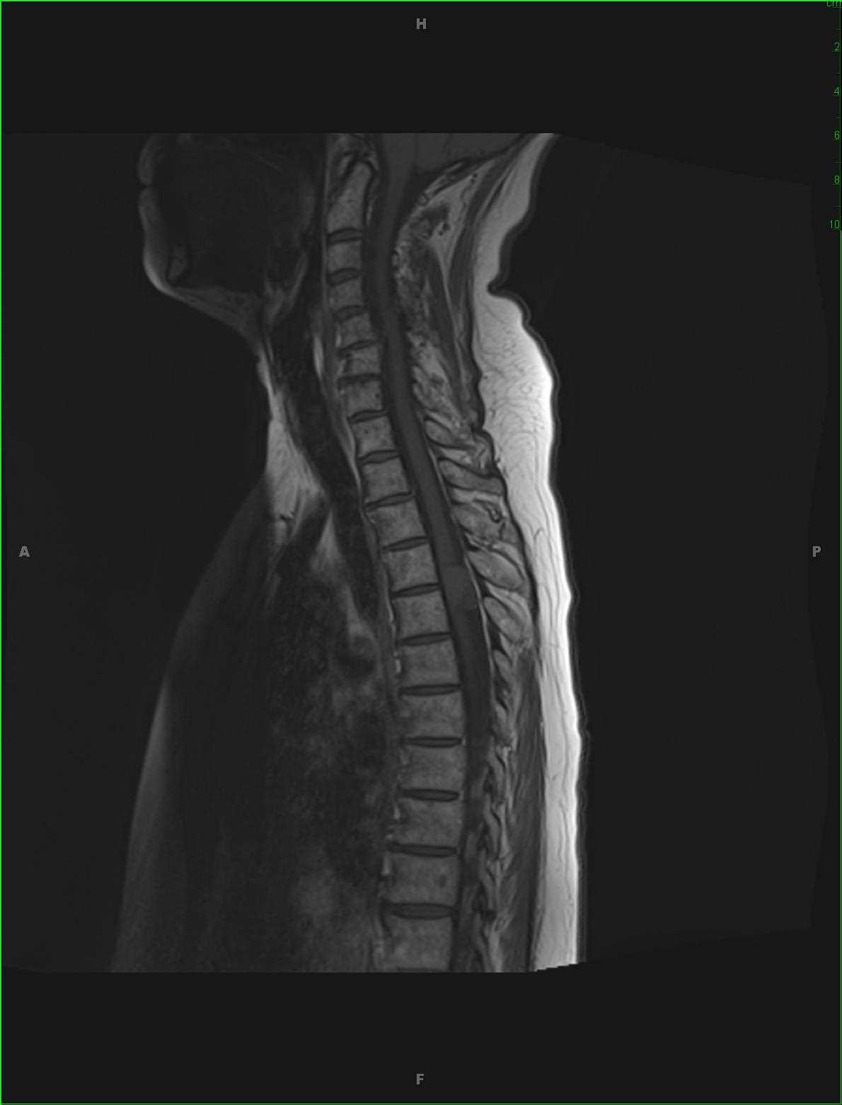 Meningioma, Thoracic Spine - CTisus CT Scan