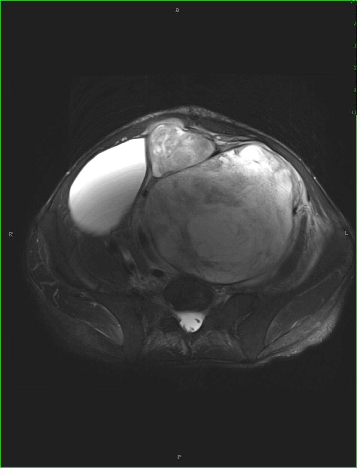 Triton Tumor - CTisus CT Scan