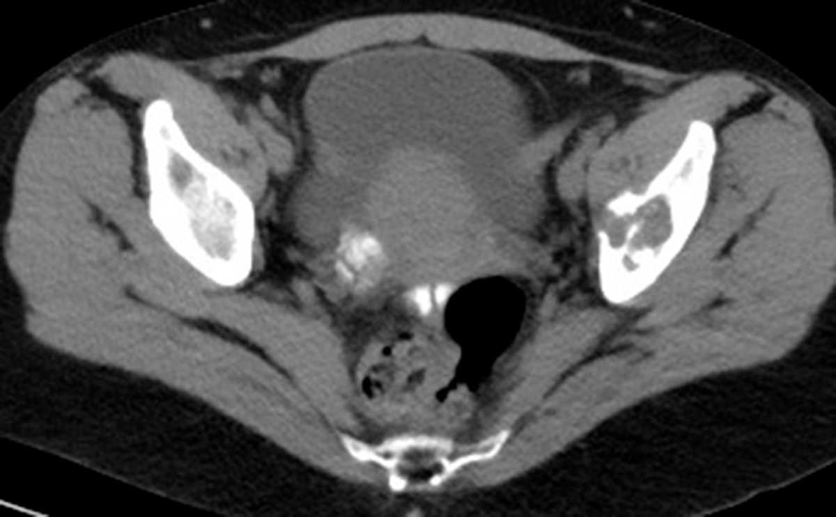 Chondrosarcoma of the Acetabulum - CTisus CT Scan
