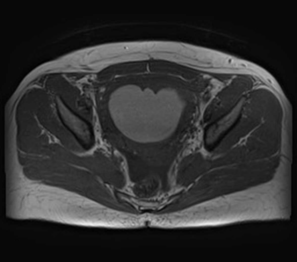 Uterine Fibroid with Red Degeneration - CTisus CT Scan