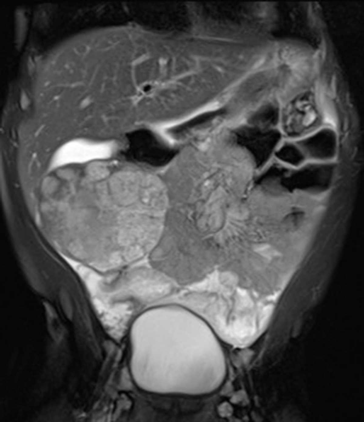 Hepatoblastoma - CTisus CT Scan