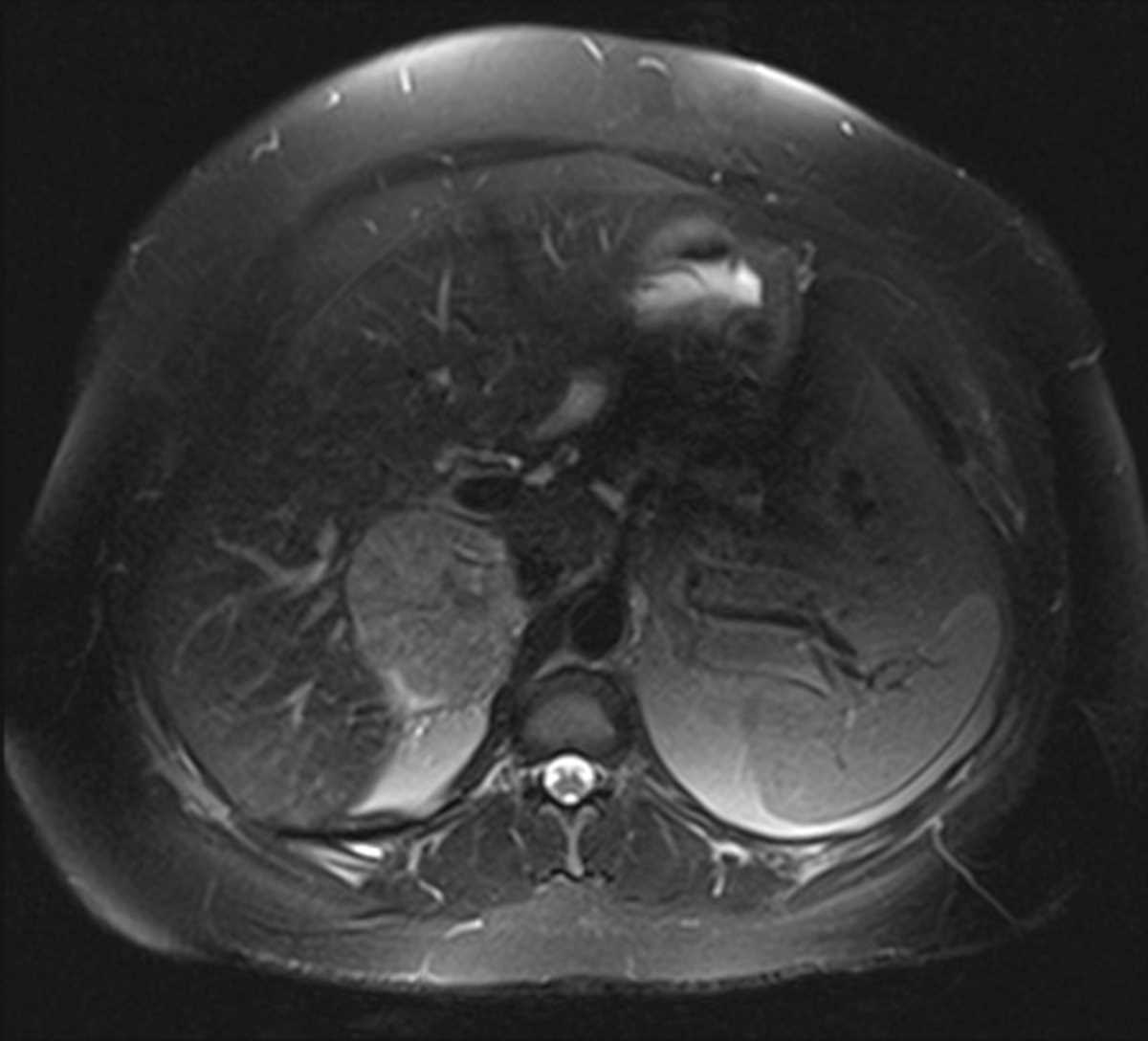 Adrenocortical Carcinoma - CTisus CT Scan