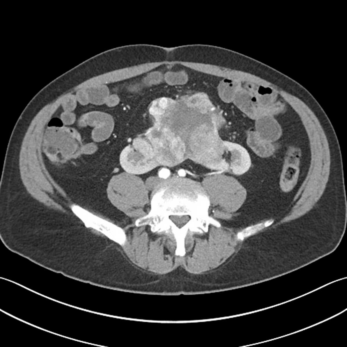 Renal Cell Carcinoma in Horseshoe Kidney - CTisus CT Scan