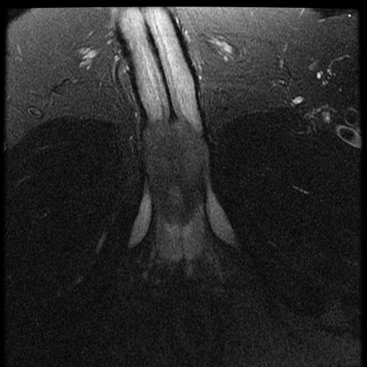 Squamous Cell Carcinoma of the Penis - CTisus CT Scan