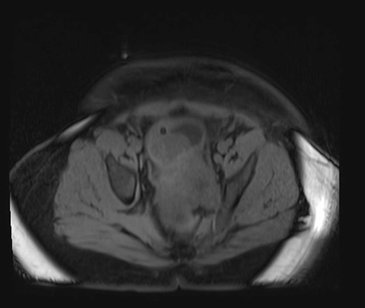 Prostate Sarcoma - CTisus CT Scan