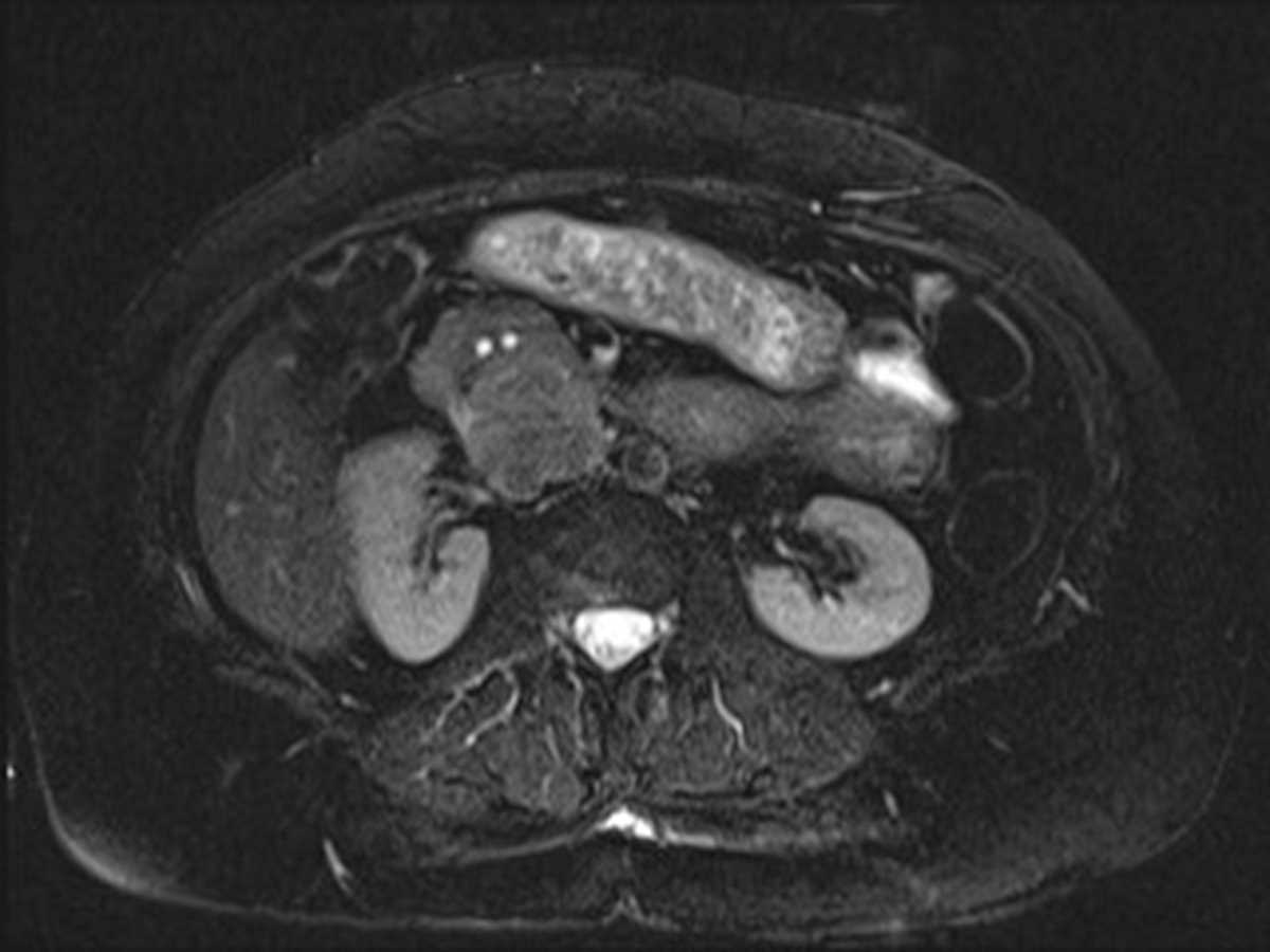 Retroperitoneal Leiomyosarcoma - CTisus CT Scan