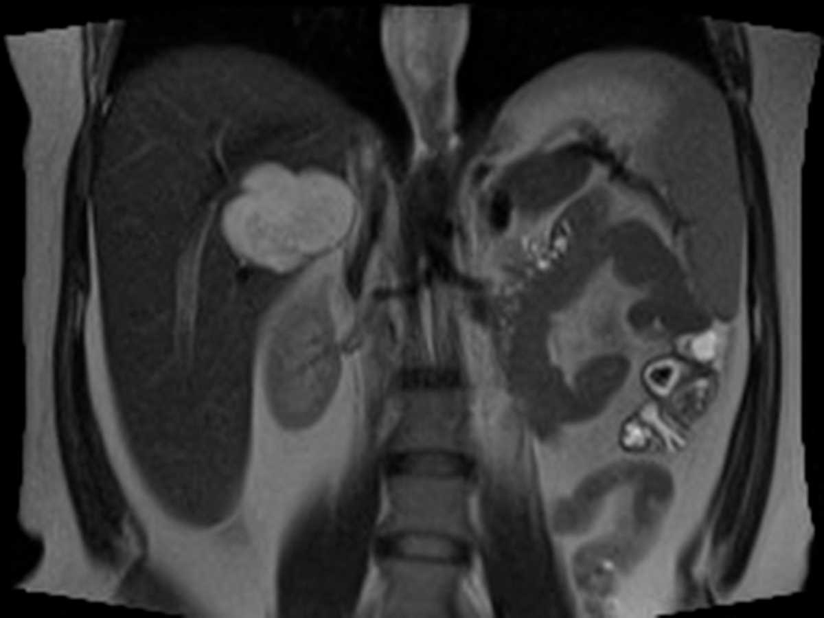 Liver Hemangioma - CTisus CT Scan
