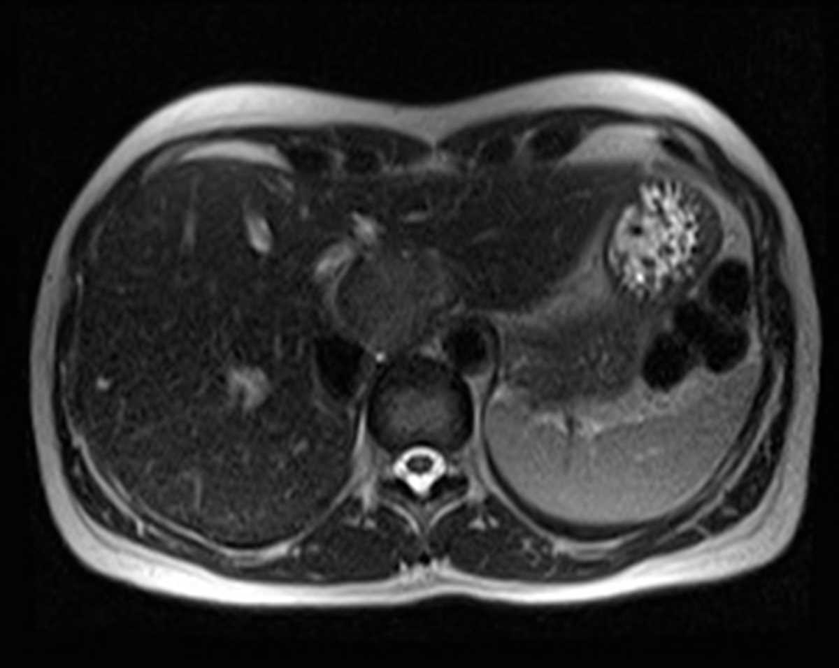Focal Nodular Hyperplasia (FNH) - CTisus CT Scan