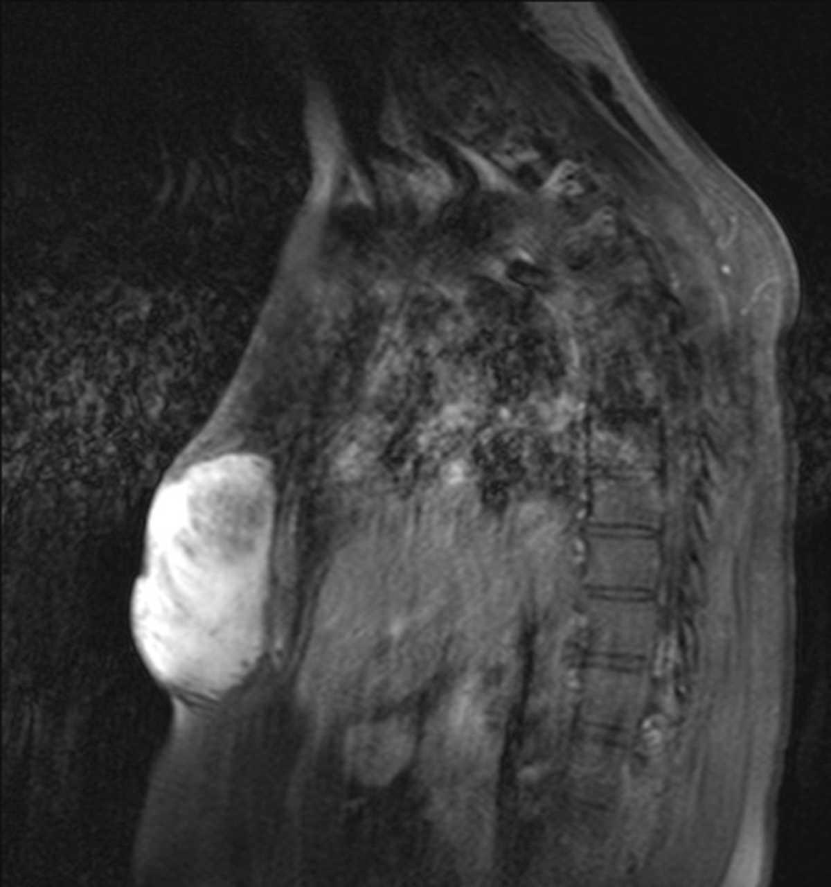 Desmoid Tumor - CTisus CT Scan